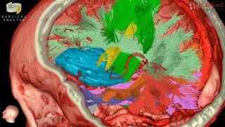 Stanford Virtual Reality: V1 HDFT Surgical Theater Fly Through