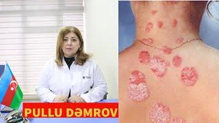 Psoriaz xəstəliyi (Pullu dəmrov) haqqında