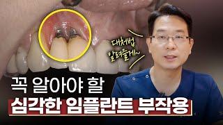 임플란트 치료가 끝났다고 끝난 게 아니다? 이런 사람들은 주의해야 합니다!