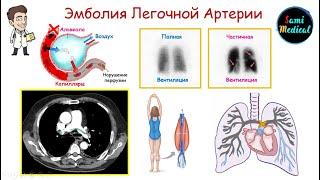 Эмболия Легочной Артерии| Основные аспекты| Патогенез| Клиника| Диагностика| Лечение| Легко и просто