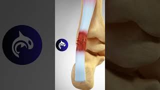 Achilles Tendonitis and Rupture - 3D Animation #achilles #foot #feet