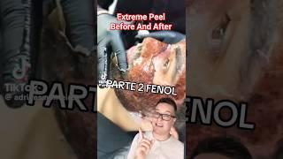 (TW!) SHOCKING CHEMICAL PEEL - Phenol Peel Before and After #shorts