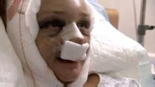 Pandora's Surgery for Smoke-Damaged Skin - 10 Years Younger