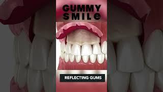 Gummy Smile Treatment { Crown Lengthening }