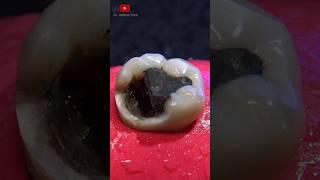 Indirect dental restoration #satisfying