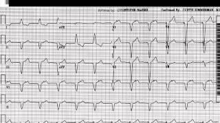 EKG Interpretation: Beyond the Basics