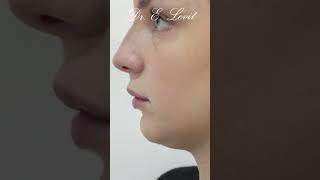 Non surgical chin fat reduction