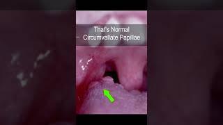 Strange ENT factoids. The “It is abnormal!” But is actually NORMAL circumvallate papillae. #shorts