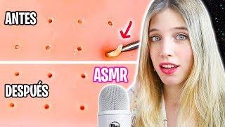 ASMR EXPRIMIENDO ESPINILLAS (MUY SATISFACTORIO Y RELAJANTE)