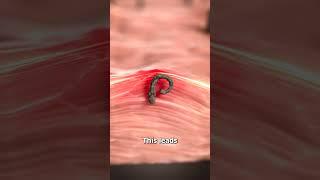 What Is An Ingrown Hair? 