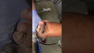 LONGEST & THICKEST TOENAILS EVER! #ingrowntoenail