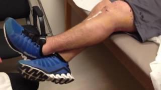 Knee exercises After ACL Reconstruction