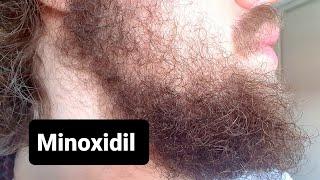 Minoxidil Beard - Week 61 | TIME FOR A CHANGE!!!