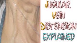 What Is Jugular Vein Distention | Something In About 5 Minutes | Medic Materials