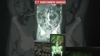 CT ABD ANGIO #angiography #arteries @hemantkushwah3453