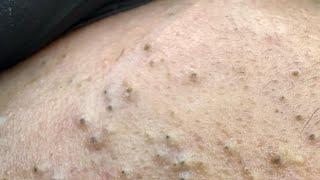 SKIN CARE ROUTINE | Deep Cleansing | BLACKHEAD & WHITEHEAD REMOVAL