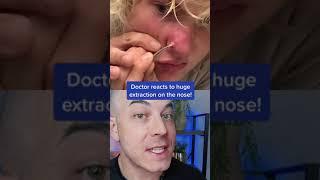 Doctor reacts to massive nose pimple extraction! #nosepimple #pimplepopper #dermreacts