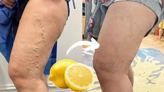 Lemon Removes Varicose Veins! This Is What You Need To Do...