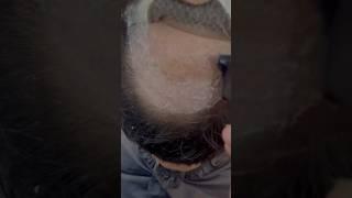 Hair patch for men. Hair patch service. Best hair patch centre in Kolkata. Glue fixing method patch