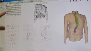 Surface Topography with the Diers Formetric for Scoliosis and Posture