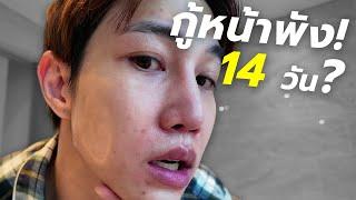 ลอง! รักษาสิว ด้วยตัวเอง แบบเร่งด่วน ยุค 2024?? | เอามั้ยลองไมค์