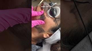 Carbon Laser Hollywood Peel #carbonlaser #hollywoodpeel