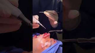 Piezo Rhinoplasty