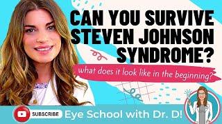 Can You Survive Steven Johnson Syndrome? What Does Steven Johnson Syndrome Look Like In Beginning?