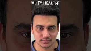 Nine Months Hair Transplant Results | Latest Fue Technique #shorts #viral #hair transplant