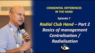 Congenital hand differences: Episode 7 -Treatment of Radial Club Hand-Centralisation, Radialisation