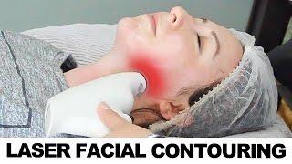 Laser Facial Contouring - Alma Accent Body and Face Contouring