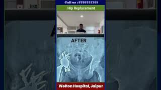 Patient testimonial after successful #hipreplacementsurgery done at Welton hospital Jaipur #thr