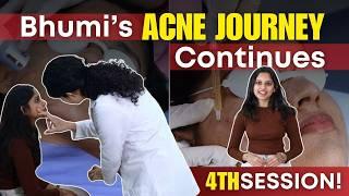 Struggling with Acne? Here’s What Actually Works! | Acne Treatment Vlog Part 4 | Clear Skin, Pune