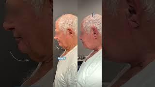 Neck Fat Solutions: Expert Insights #liposuction #renuvion #necklift