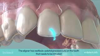 Smiletech: Intrusion Elastic