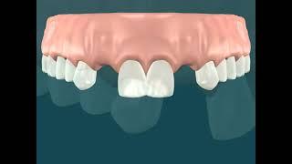 Dental Video for Root Tipping for Implants - The Tooth