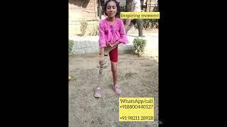 Dancing with prosthetic leg#08800440127 #artificialleg #child prosthetic #prostheticleg #artificial