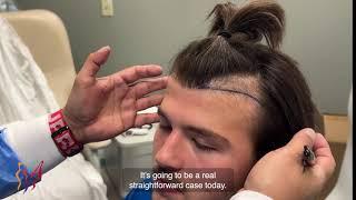 Hair Transplantation with SmartGraft & FUE  Expert Guide by Dr. Jon Mendelsohn - Advanced Techniques