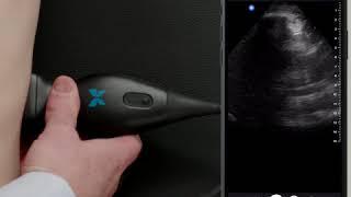Ultrasound Education:  FAST Exam Basics, Left Upper Quadrant
