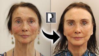 The future of cosmetic surgery - Amazing 8 week facelift transformation! Dr. Julian De Silva