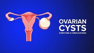 Ovarian Cysts - Symptoms and Complications Explained by an OB-GYN