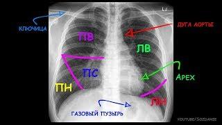 Рентгеноанатомия грудной клетки за 5 минут