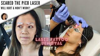 How I got my microblading removed (Before & After)-Part 2