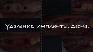 Три в одном. Удалим, поставим, подсадим.