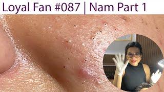 Acne Treatment Huong Da Nang# 087 |  Loyal fans _ Nam Part 1