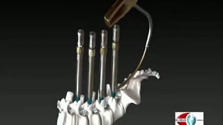 Globus Medical: REVOLVE Minimally Invasive Spine