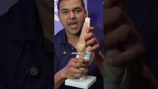 The root problem that causes meniscus tears 