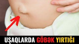 Uşaqlarda Göbək Yırtığı Zamanı Bunları ETMƏYİN!