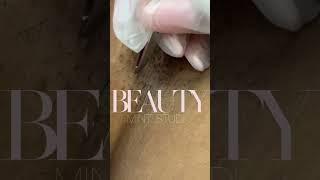 Ingrown Hair Removal