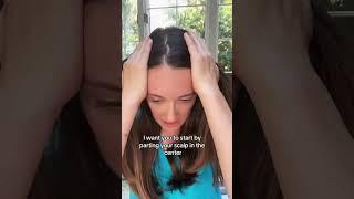 Female Pattern Hair Loss #alopecia #hair